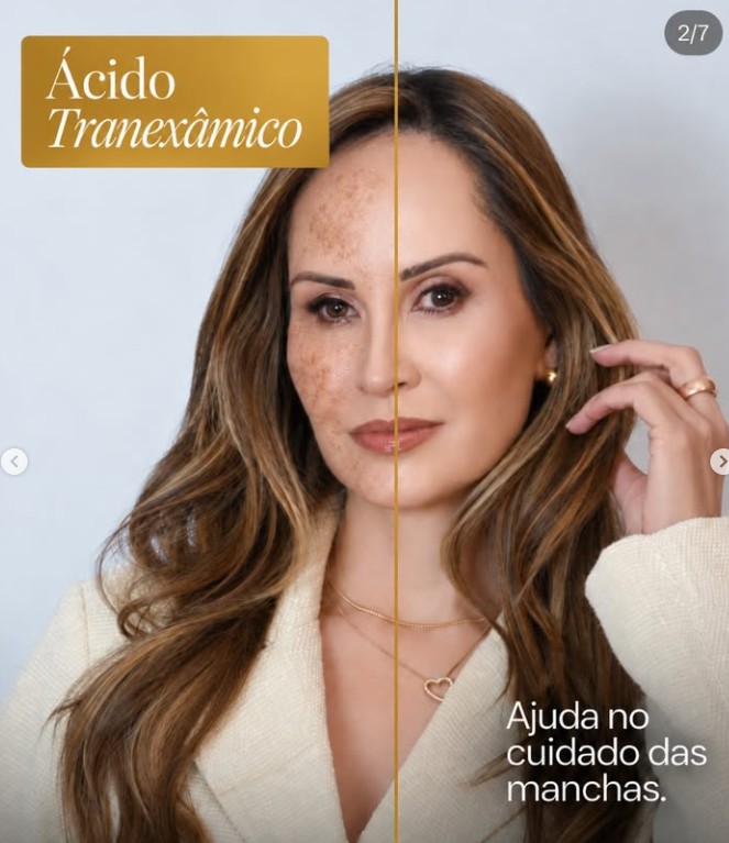 Ácido Tranexâmico