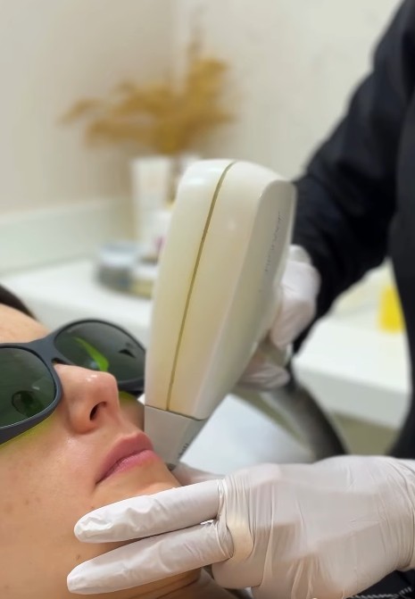 Tratamento a laser